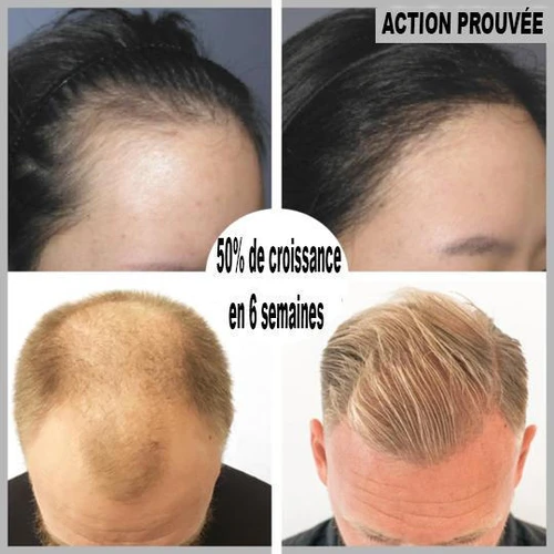 Sérum de repousse des cheveux en Roll-on
